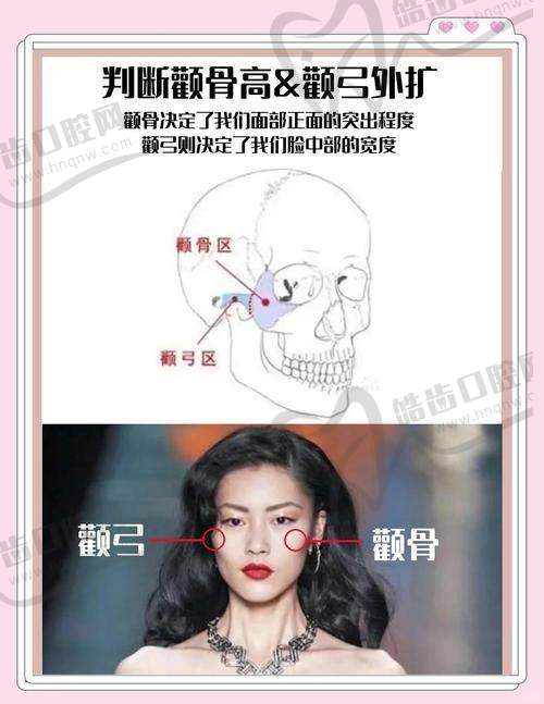 安心医美医院解析颧骨内推术后修复周期与常见反应