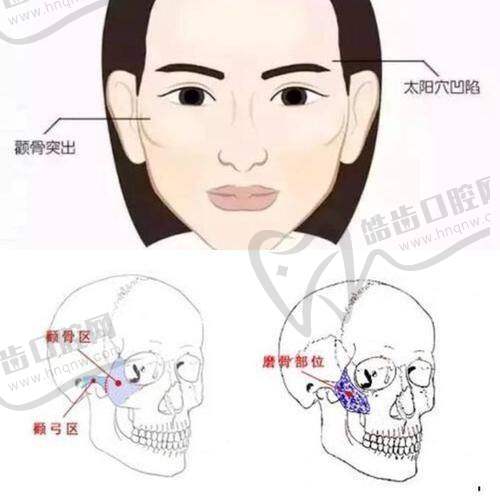 雅美医疗美容医院:术后修复各阶段骨缝的“变化轨迹”