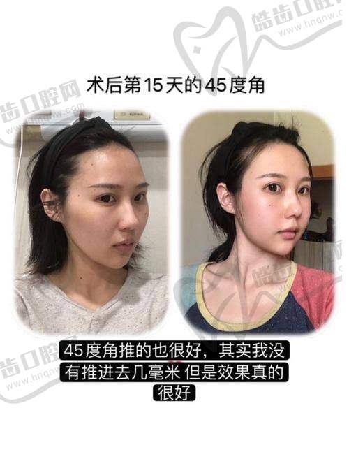 雅美医疗美容医院详解骨缝1-3mm正常范围的科学依据