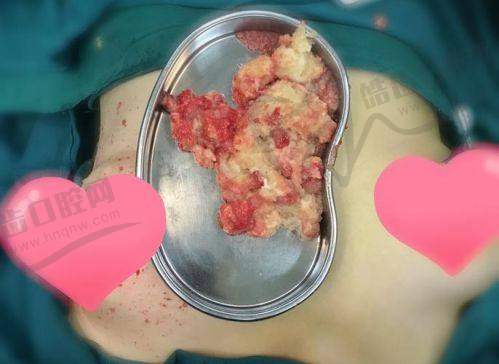 焕颜医美整形医院提醒:异常增生需警惕——及时干预是关键