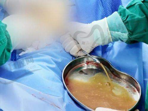 焕颜医美整形医院解读面部填充后生长因子增生时间——1-3个月是关键观察期