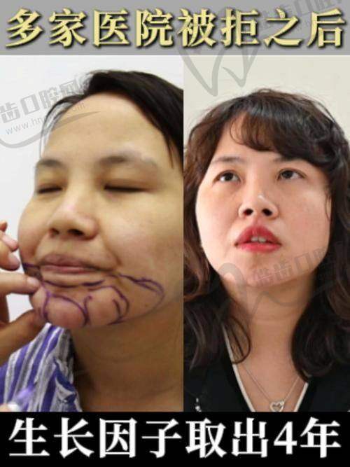 焕颜医美整形医院解析生长因子作用机制——刺激细胞生长非“无止境”增生