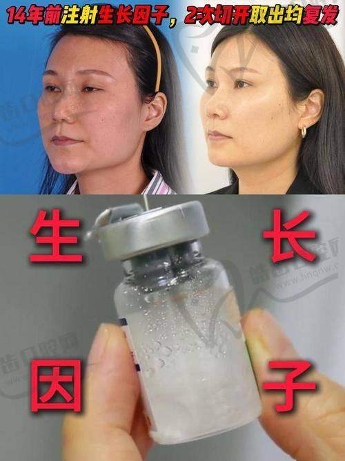 焕颜医美整形医院揭秘影响生长因子代谢的关键因素——注射量与个体差异是核心