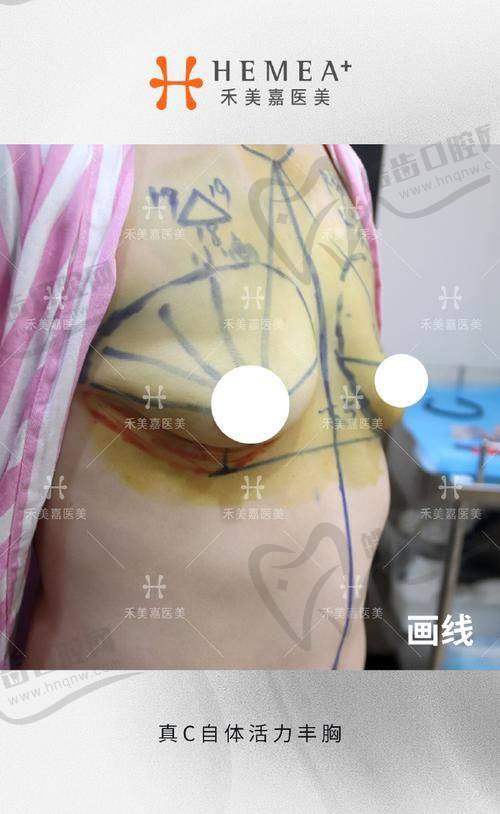 美波婷胶原蛋白丰胸的成效表现:即时逆袭,长期在线