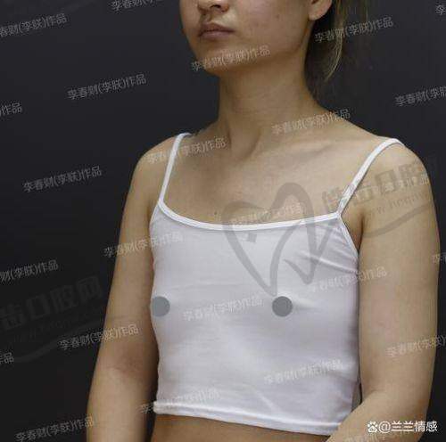 美波婷胶原蛋白丰胸的安心性:人体同源+可逆,放心变得更美无负担