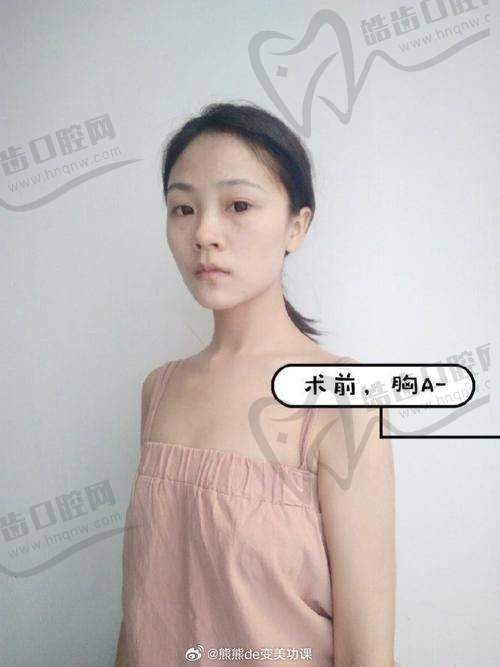 美波婷胶原蛋白丰胸的真实实例:她们都靠它找回自信